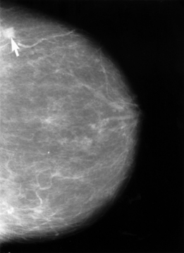 The arrow on this mammogram points to a small ...